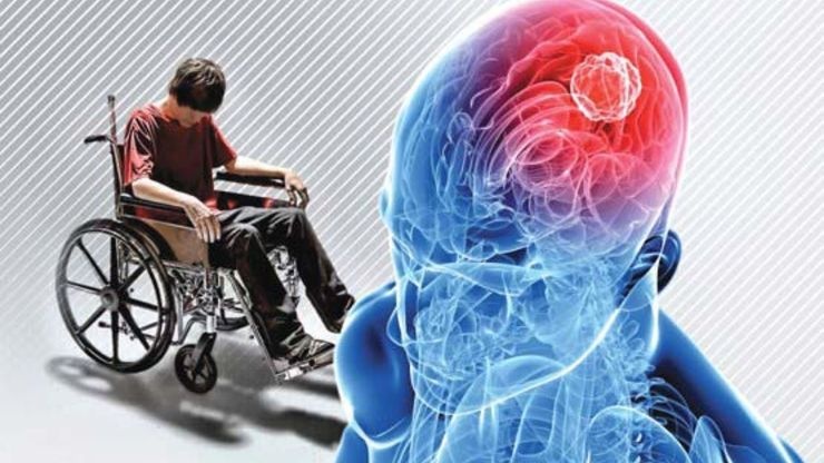 کلینیک تخصصی ذوب‌آهن برای بیماران ام‌اس راه‌اندازی شد